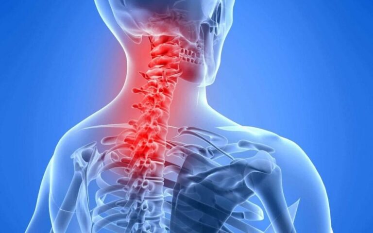 illustration of an xray of a patient suffering from neck pain